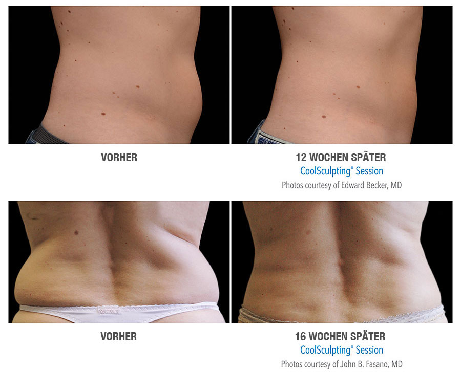 Coolsculpting Vorher Nachher 04 Fett Einfrieren De