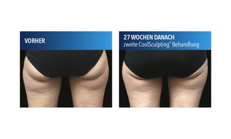 Coolsculpting Gesass Vorher Nachher Asthetik Berlin Fett Einfrieren De