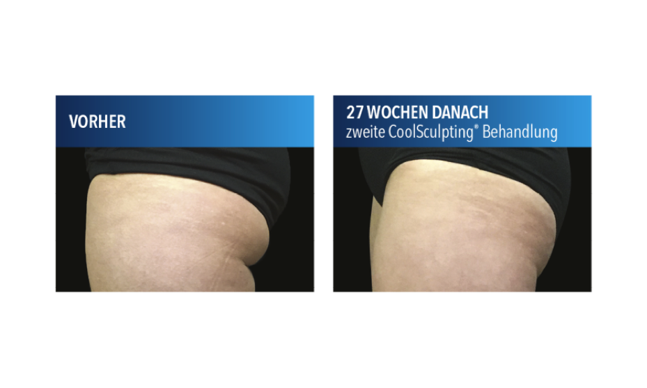 Coolsculpting Gesass Vorher Nachher Asthetik Berlin Fett Einfrieren De