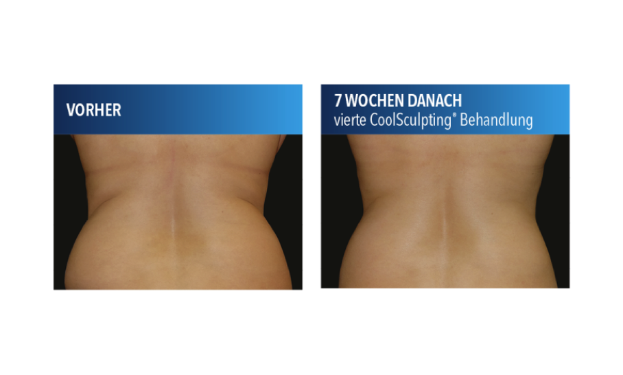 Coolsculpting Hufte Vorher Nachher Asthetik Berlin Fett Einfrieren De