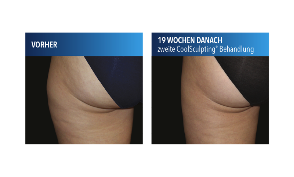 Coolsculpting Oberschenkel Vorher Nachher Asthetik Berlin Fett Einfrieren De